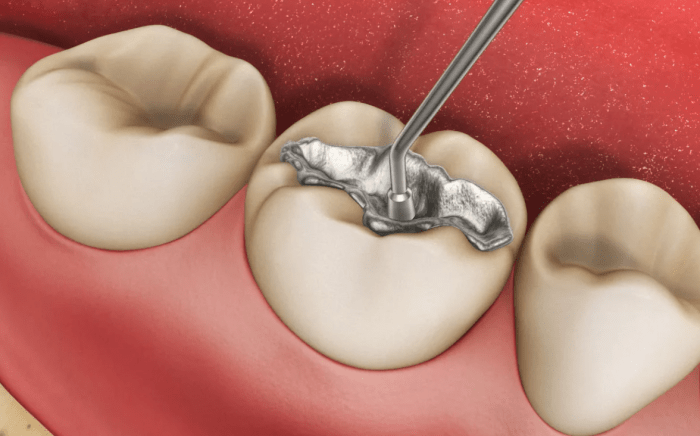 Как устанавливается пломба на зуб?