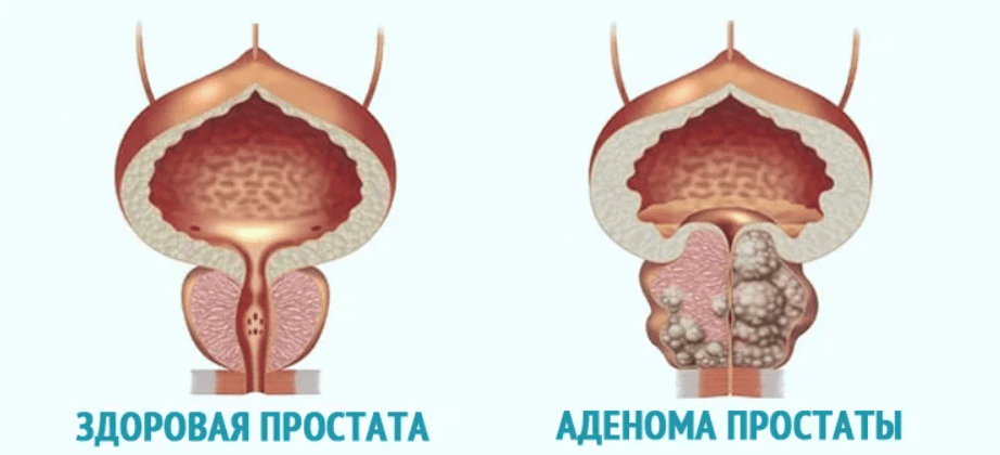 Д простату. Доброкачественная гиперплазия (аденома) предстательной железы. Аденома предстательная железа у мужчин.