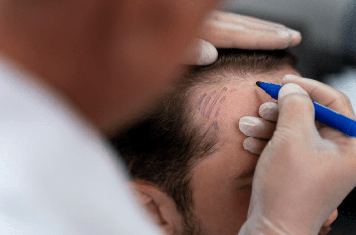 Миноксидил для волос: эффективное средство против выпадения и для роста