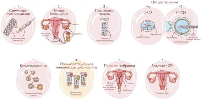 Бесплодие при варикоцеле: причины, лечение и можно ли забеременеть
