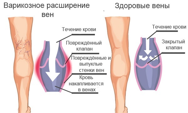 Боли в ногах при варикозе: симптомы (как болит), почему и как обезбаливать