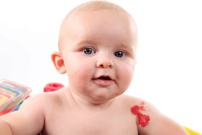 Гемангиома на голове у новорожденного ребенка: причины, диагностика, лечение, осложнения