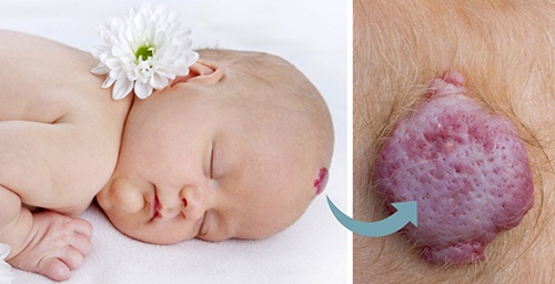 Гемангиома на голове у новорожденного ребенка: причины, диагностика, лечение, осложнения