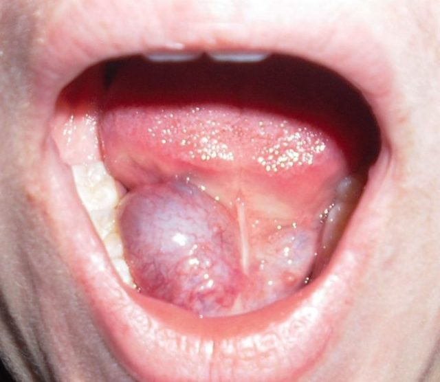 Гемангиома на губе и во рту у взрослых и детей: виды, причины, симптомы, диагностика и лечение