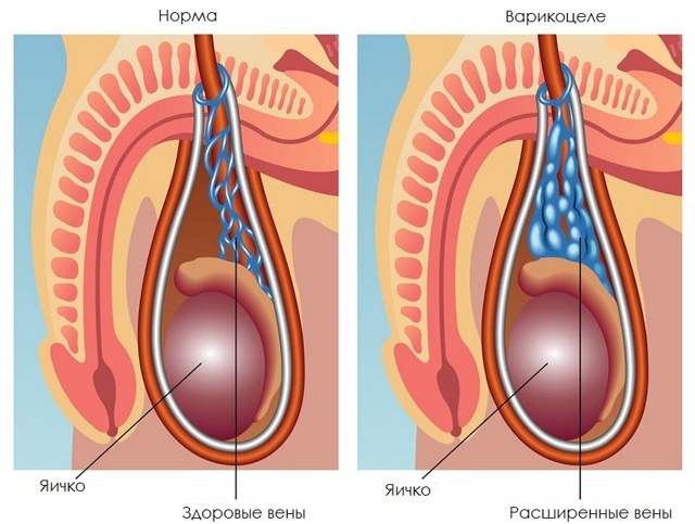 Секс после операции на варикоцеле: влияние на длительность полового акта, онанизм (мастурбация)