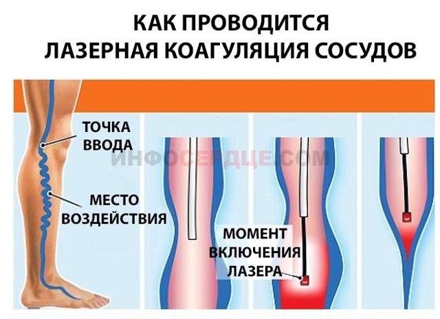 Удаление вен при варикозе на ногах: подготовка, виды, последствия