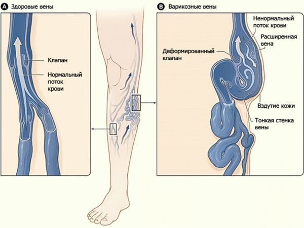 Варикоз глубоких вен нижних конечностей: симптомы, лечение, профилактика и осложнения