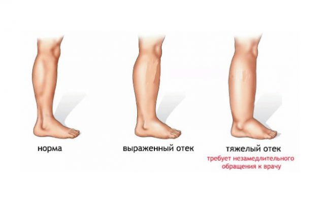 Варикоз глубоких вен нижних конечностей: симптомы, лечение, профилактика и осложнения