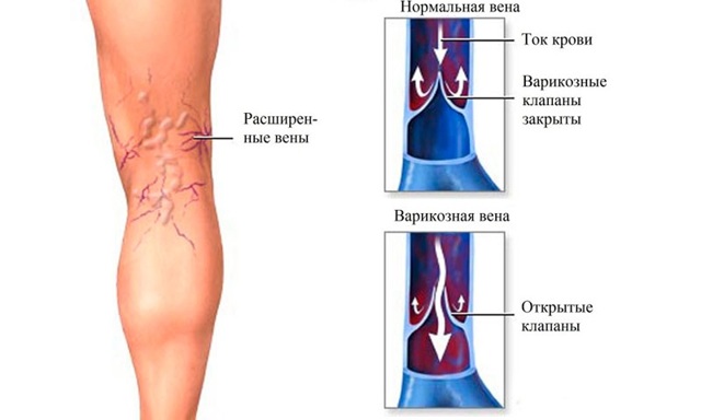Варикоз на ногах у мужчин: как лечить, симптомы и признаки, чем опасен, профилактика, последствия