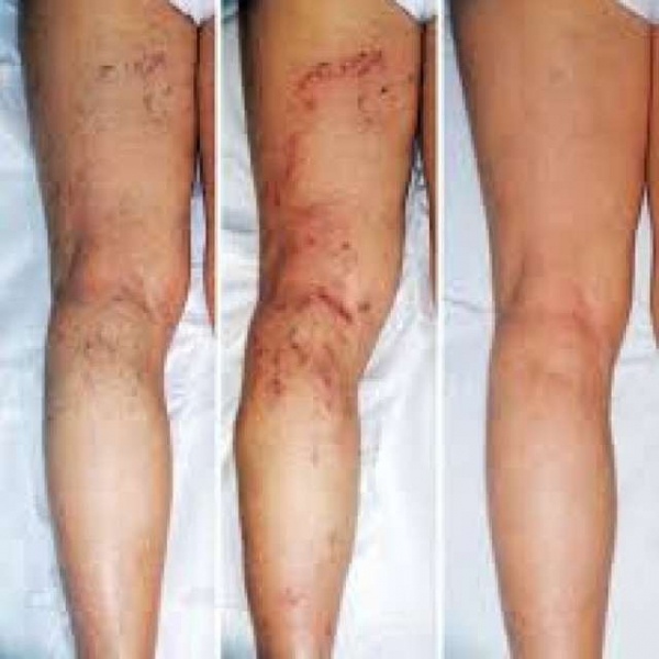 Варикоз на ногах у женщин: причины, симптомы, диагностика, стадии, лечение (медикаментозное, оперативное, народное), профилактика, осложнения