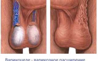 Влияет ли варикоцеле на потенцию: влияние на тестостерон, лечение импотенции, эффект от операции