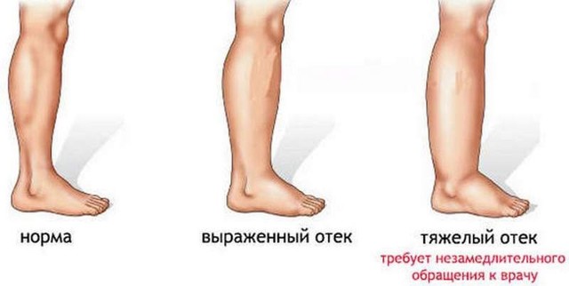 Внутренний варикоз на ногах (скрытый): симптомы и лечение