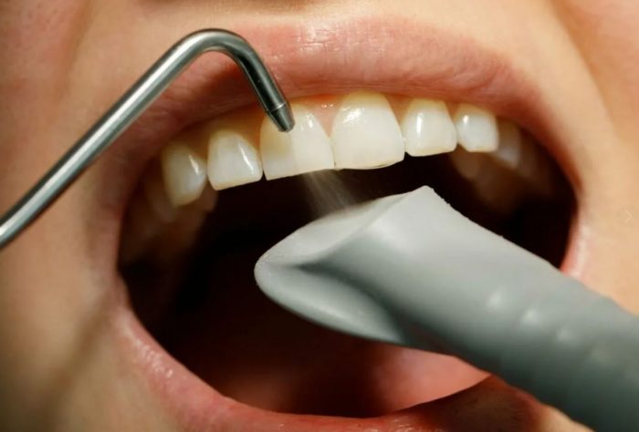 Особенности чистки зубов методом Air Flow